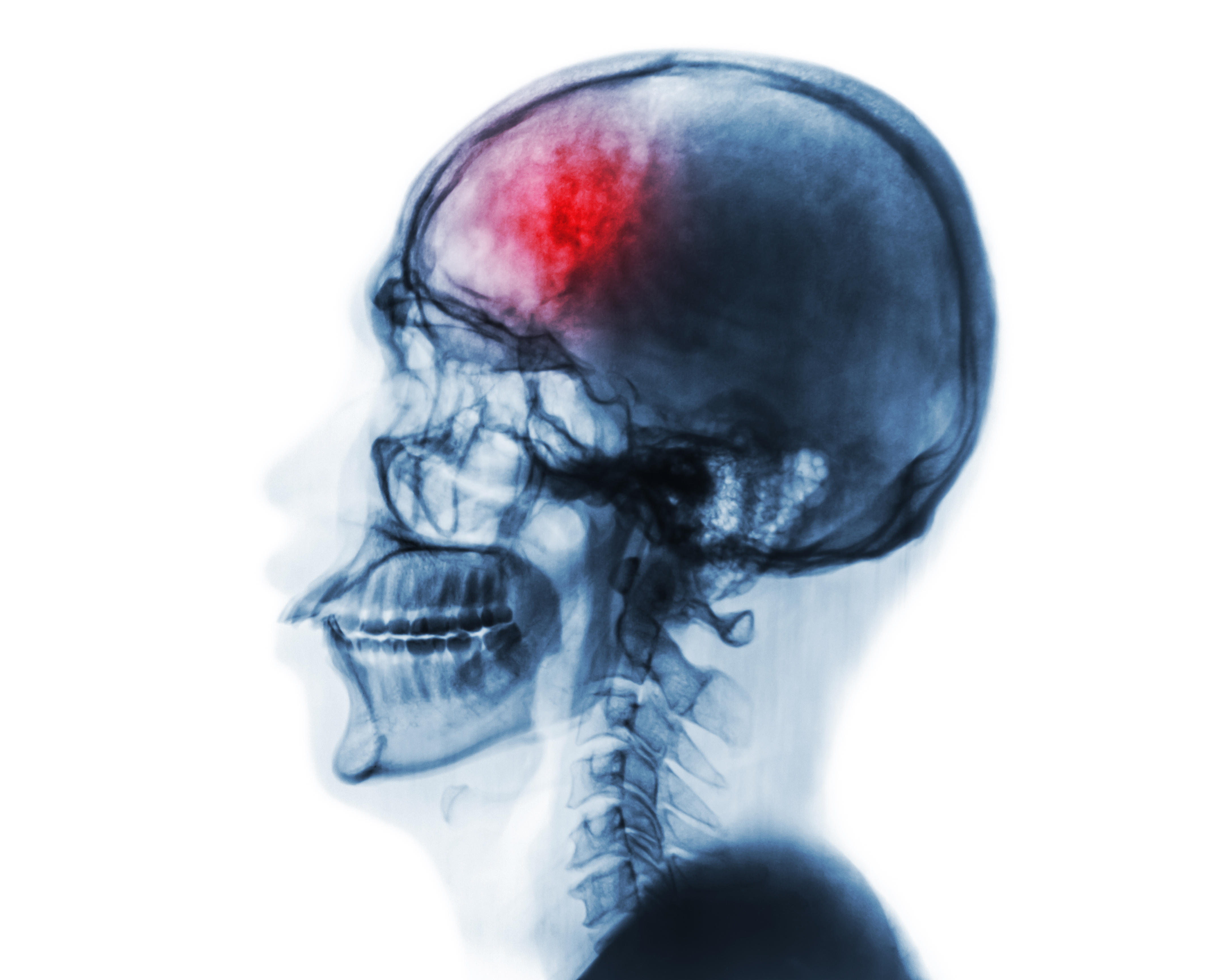 Brain 23. Рентгенография черепа и позвоночника. Рентгенография черепа и позвоночника неврология. Цереброваскулярных заболеваниях снимки рентгена. Рентген черепа патология.